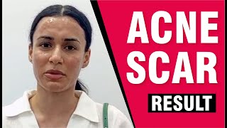 Testimonials: Effective Treatments for Acne, Scars, and Pigmentation Sakhiya Skin Clinic Review