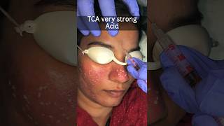 TCA CROSS ACNE SCARS @DesignerDoctor #acnescartreatment #shorts #viral