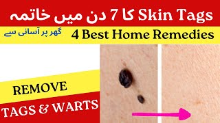 Disappear Skin Tags and Warts in 7 Days | موکے اور مسے ختم گھر پر 7 دن میں