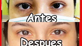 HOW I FIXED MY UNEVEN EYES 2- Parpados y Ojos Desiguales | Eyelid tape Raigna Vargas