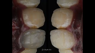 MANAGING AN EXTREMELY DISCOLOURED TOOTH WITHOUT BLEACHING OR ANY RESTORATION