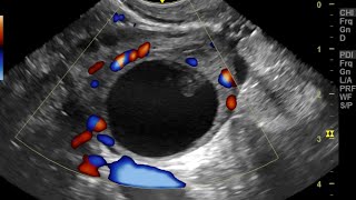 6 Weeks Amenorrhea with adnexal cyst: Ultrasound Findings and Diagnostic Possibilities Explained