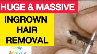 Ingrown Hair Removal | Oddly Satisfying Ingrown Hair Extraction