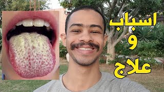 اسباب و علاج فطريات الفم/ Oral Thrush