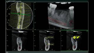 Basic Virtual (Custom) Implant Planning for patient education using 3D CBCT technology.