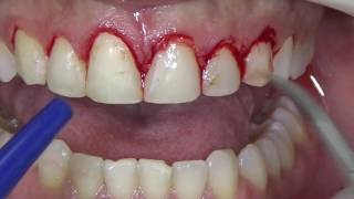 Cirurgia para sorriso gengival