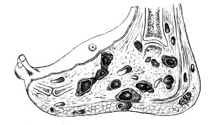 What Is Mycetoma ?