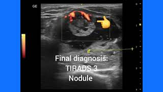 Colloid cyst thyroid with mural nodule, how to analyze, TIRADS Score ultrasound and color Doppler