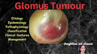 238. Glomus tumor of Temporal bone #surgeryeducation