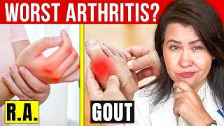 The 3 Most Severe Types of Arthritis Doctors Warn About!