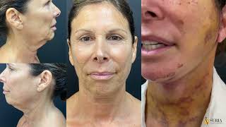 Lower Face & Neck Lift Weston Florida Cosmetic Surgery @suriaplasticsurgery  Dr. Shashi Kusuma