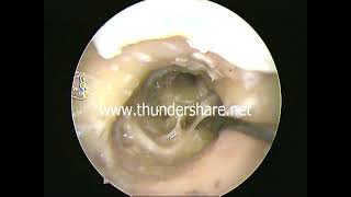 FN decompression (TB dissection) relationships FN,Pyramid, HSCC,oval window-dr.shreekantha acharya