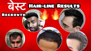 बेस्ट BEST Hair-Line Results Ever| Receding|TRANSPLANT|LOSS|Finasteride|minoxidil|Results|hindi|fall