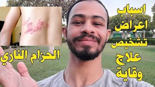 الحزام الناري(Shingles) اسباب، اعراض، تشخيص، علاج، وقاية - دواك موجود