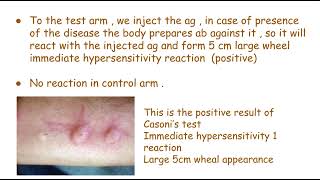 Casoni’s test | hydatid disease | mbbs