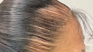 ALOPECIA POR TRACCIÓN | ¿Qué es?, tratamientos