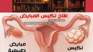 ما هو مرض العصر عند النساء وهل الحجامة تعالج تكيس المبايض وهل الحجامة تساعد في تأخر الانجاب