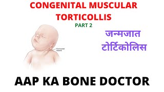 CONGENITAL MUSCULAR TORTICOLLIS - PART 2 - EPISODE 10