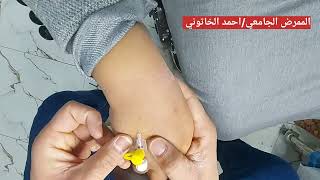 تشكيل كانيولا Cannula insertion