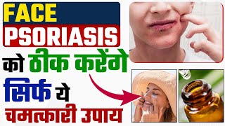 ये घरेलू नुस्खे कर देंगे फेस सोरायसिस को ठीक | How to cure face psoriasis | Psoriasis on face