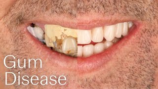 What is Gum Disease? | Dental Boutique™