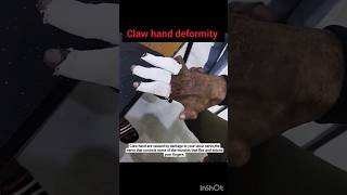 claw hand deformity 🤚#defomity#ortho#hand #muscle #physicaltherapy #youtubeshorts #shortsvideo