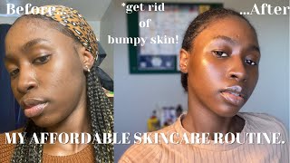 HOW I CLEARED MY ACNE | Skincare Routine for textured skin✨| MonnyLagos.