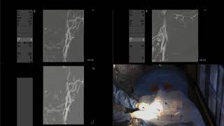 Balloon angioplasty and stenting of severe carotid stenosis