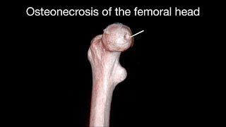 Osteonecrosis of the femoral head