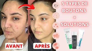 L'ACNÉ : MA ROUTINE SKINCARE + TOUTES LES SOLUTIONS POUR CHAQUE TYPE DE BOUTON !