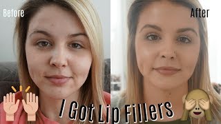 OMG | I got Lip Fillers