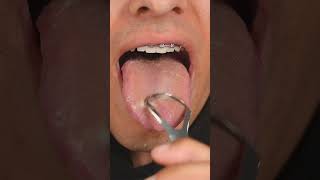 Cleaning buildup off tongue 🤢