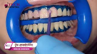 টুথ হোয়াইটেনিং চিকিৎসা ।। Tech Dental