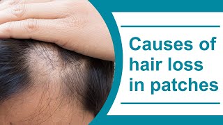 Causes of Hair Loss in Patches | Alopecia | Healthie Genie