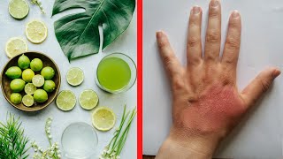 12 Effective Home Remedies For Burns | Health Tips