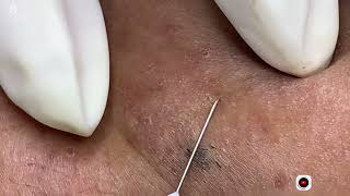 Big Cystic Acne Blackheads Extraction Blackheads & Milia, Whiteheads Removal Pimple Popping