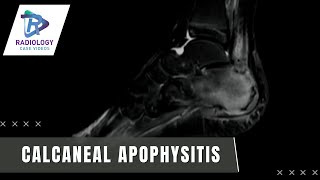 Calcaneal Apophysitis