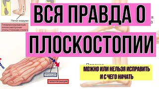 Как исправить плоскостопие? Вся правда о плоскостопии. Мастер-класс 20 февраля