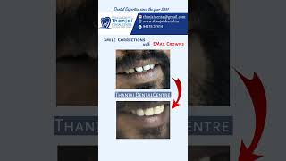 Emax crowns மூலமா உங்க smile ஓட அழக இப்போ உடனே improve பண்ணலாம்! | Thanjai Dental Centre #dentalcare