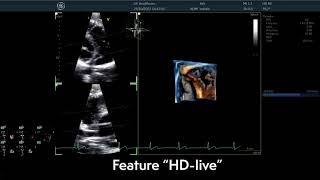 〖Echocardiography〗 The Tricuspid Valve in detail in 3D - TTE 🫀