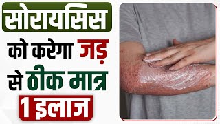 सोरायसिस का रामबाण इलाज | This Treatment Will Get Rid Of Psoriasis | सिर्फ 1 इलाज से सोरायसिस खत्म