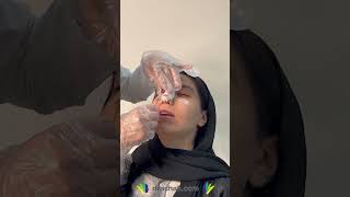 Removing External Nose Splint | Dr. Farshid Achak,