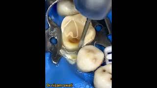 how to open teeths cavity