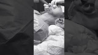 graft extraction from beard - hair transplant from bear - body hair transplant #hairregrowth