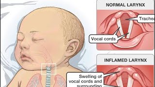 Croup خراسک