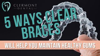 5 Ways Clear Braces Will Help You Maintain Healthy Gums #dentist #periodontalhealth #clearbraces