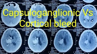 Capsuloganglionic bleed VS cortical bleed