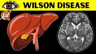 Wilson Disease - The Inherited Disorder Of Copper Metabolism - Everything You Need To Know