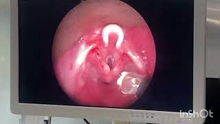 Neonatal stridor - laryngomalacia