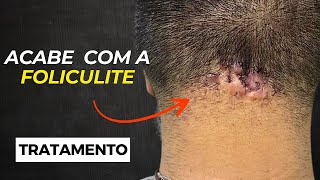 MELHORES PRODUTOS para tratar a FOLICULITE de FORMA SEGURA